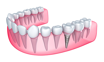 Dental Implants Huntsville
